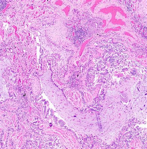 webpathology|Pulmonary .